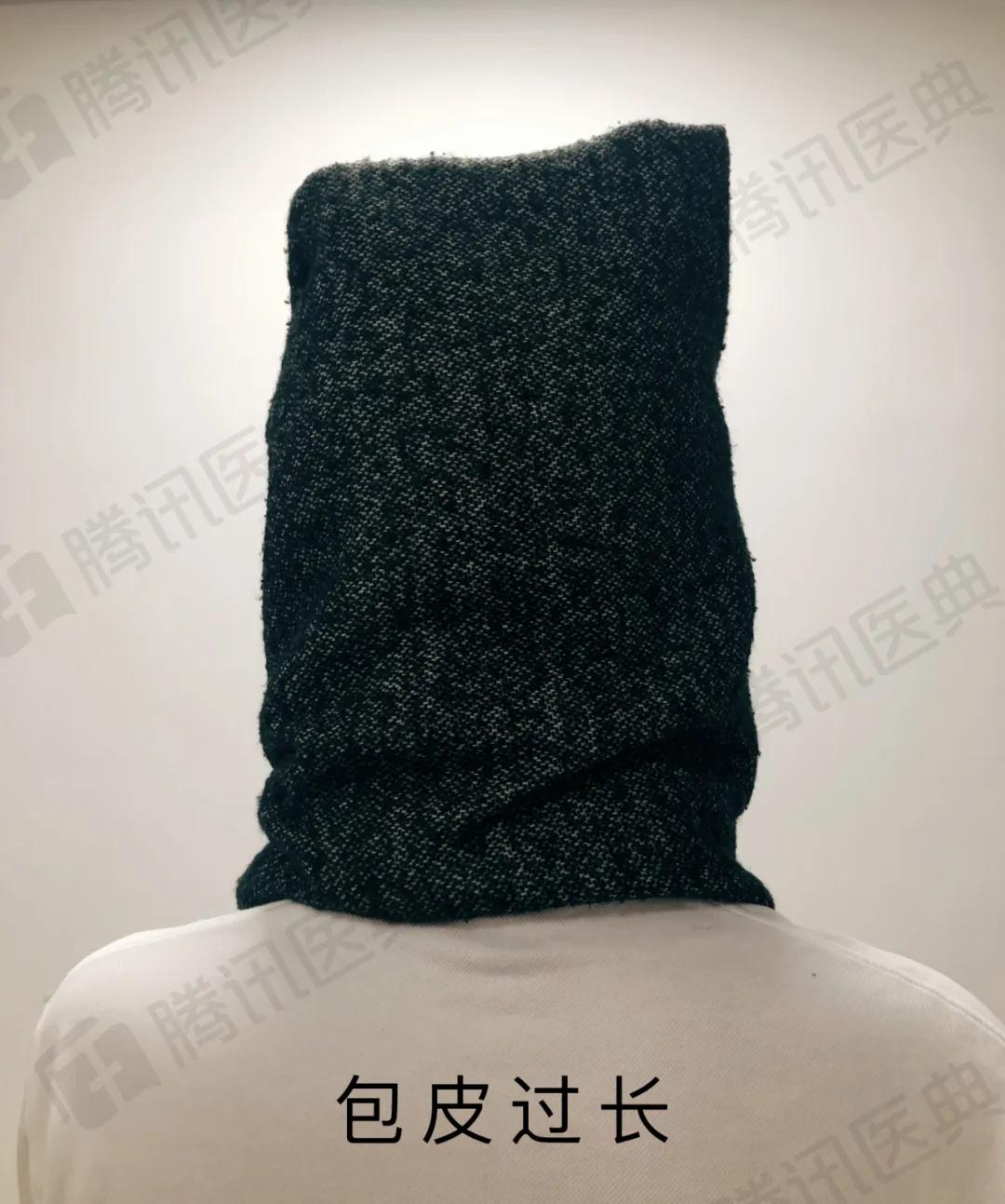 割包皮有可能割短吗,割包皮能治疗好疱疹吗