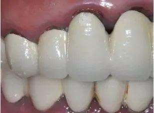 烤瓷牙崩瓷修复的详细步骤,烤瓷牙崩瓷必须更换吗