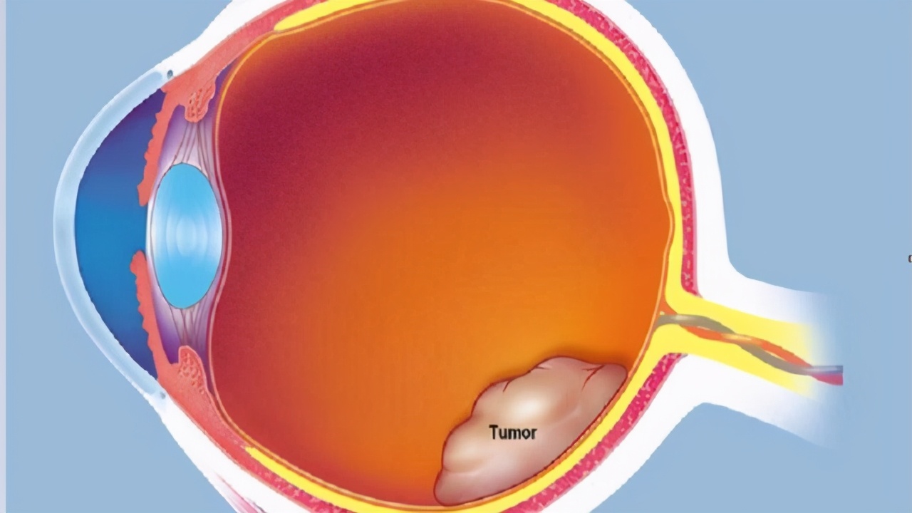 视网膜母细胞瘤恶性肿瘤,视网膜母细胞瘤是什么遗传病