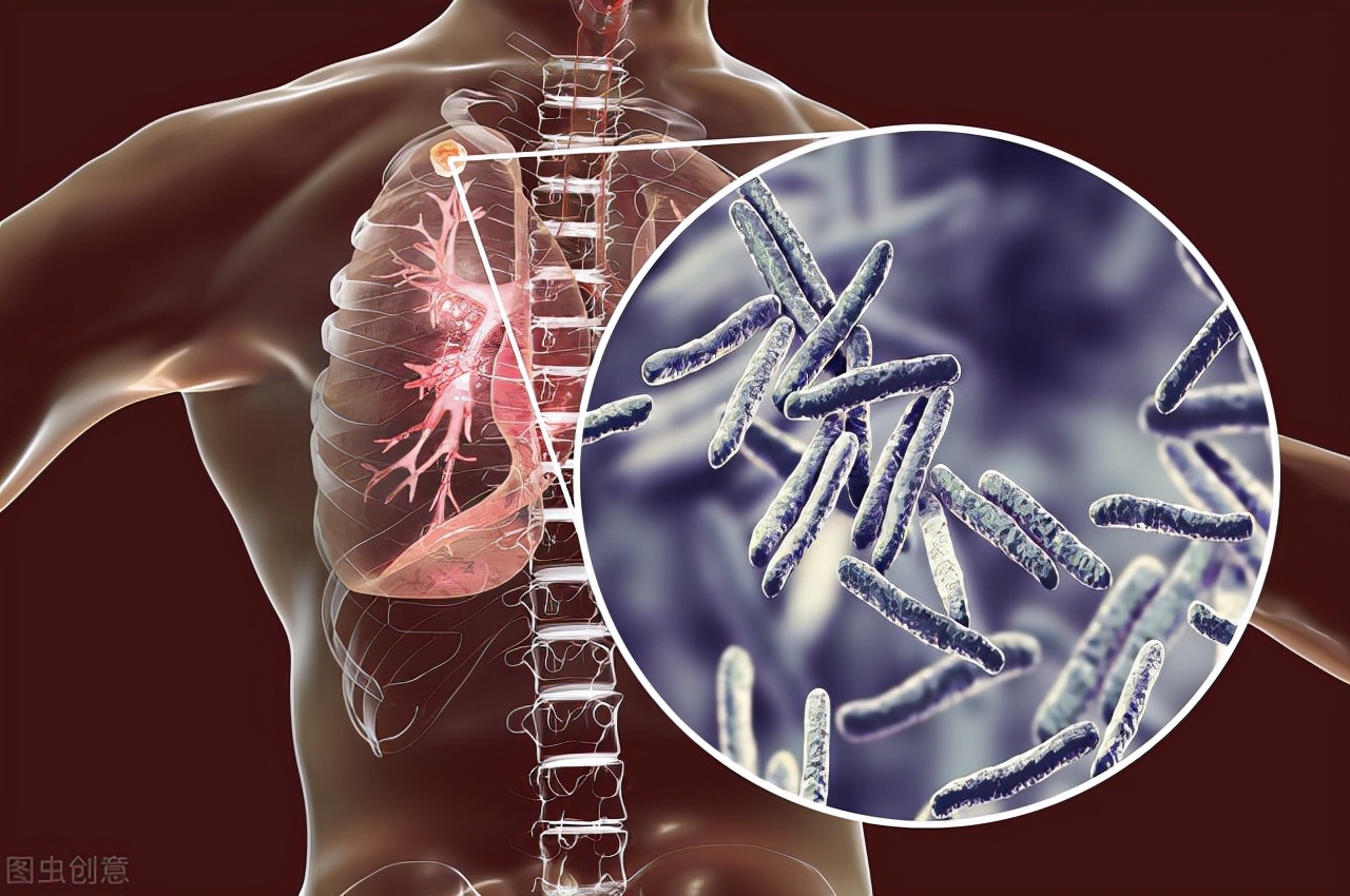 肺结节被误诊为肺炎,肺结节误诊为肺结核正常吗