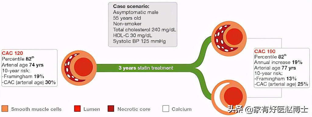 体检显示部分脑动脉钙化,体检查出了动脉斑块有何危害