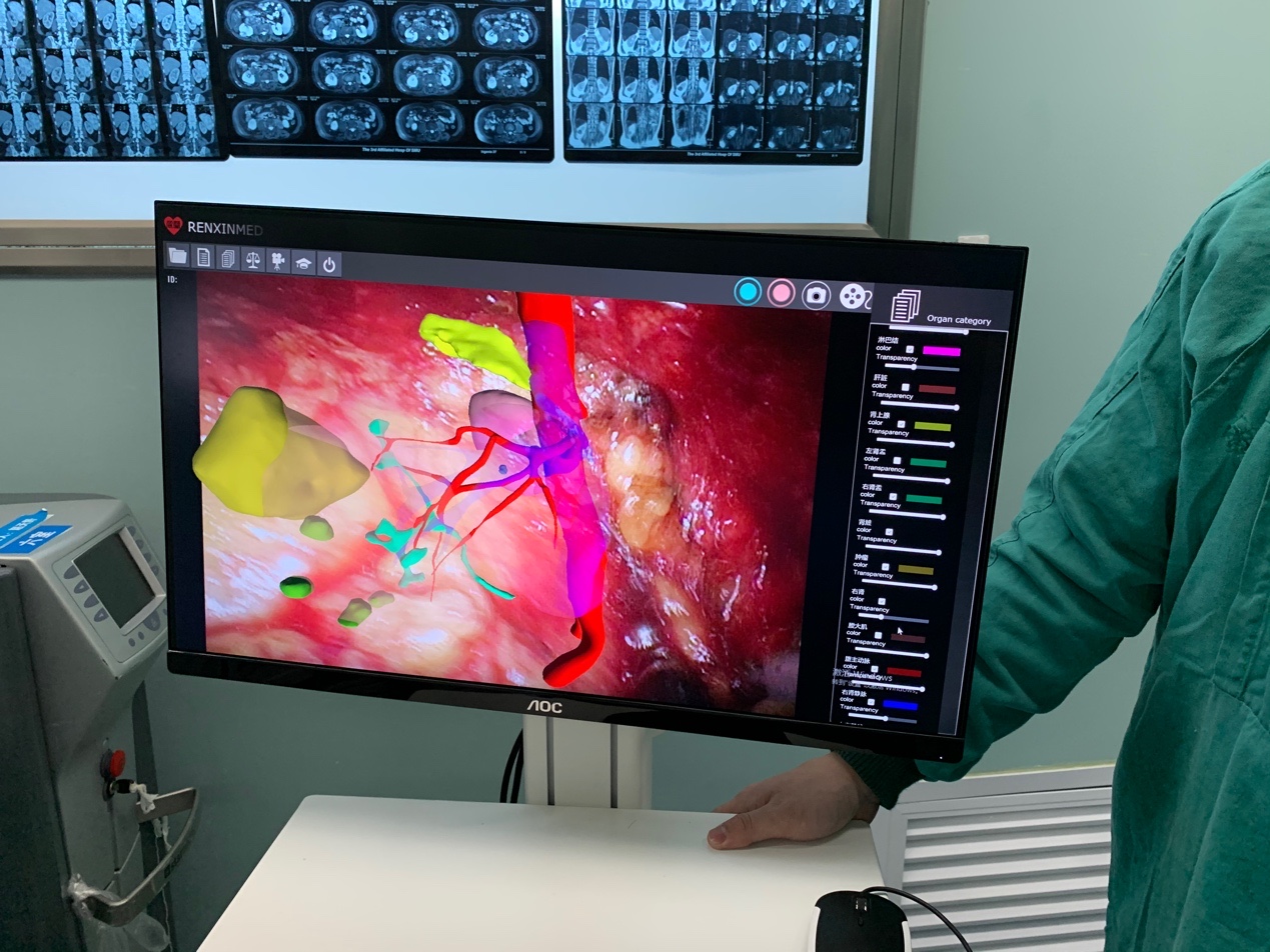 3d动画演示腹腔镜辅助手术,3d动画演示腹腔镜切除回盲部肿瘤
