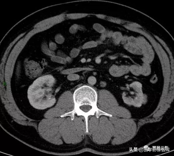 泌尿系统26种症状,泌尿系统的各疾病的体征汇总