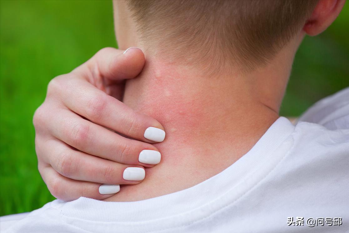 为什么有的人被蚊子叮了不痒,为什么有的人不招蚊子叮咬