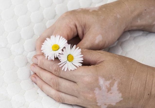 手上有白癜风能恢复吗,手上白癜风处又痛又痒