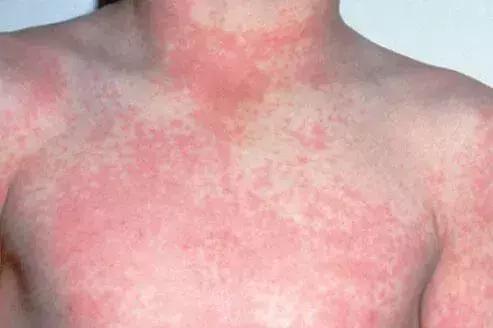 春季是各种传染病的高发季,春季是传染病的高发期吗