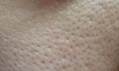 毛孔粗大怎么办教你一招收缩毛孔,毛孔粗大怎么办什么方法有效