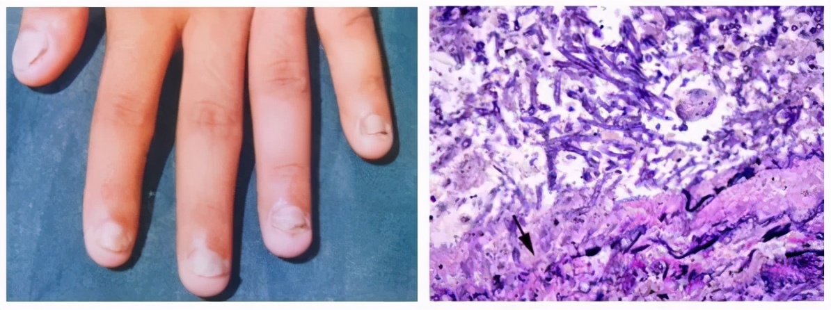 新型冠状病毒的“帮凶”——病原真菌到底是什么鬼?