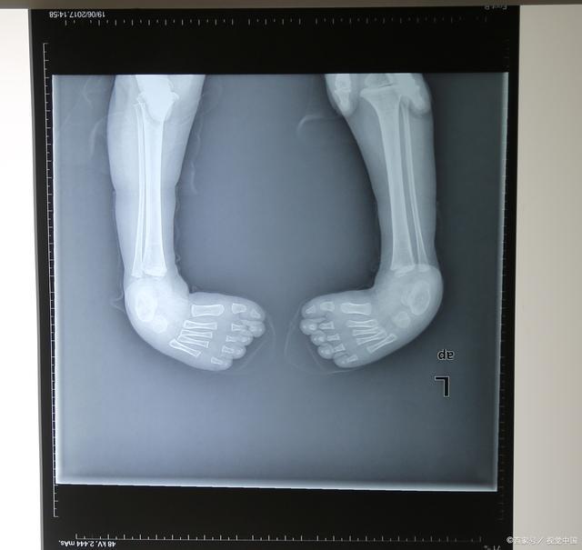 足内翻矫正鞋真的可以矫正吗,马蹄内翻足矫正鞋要穿多久