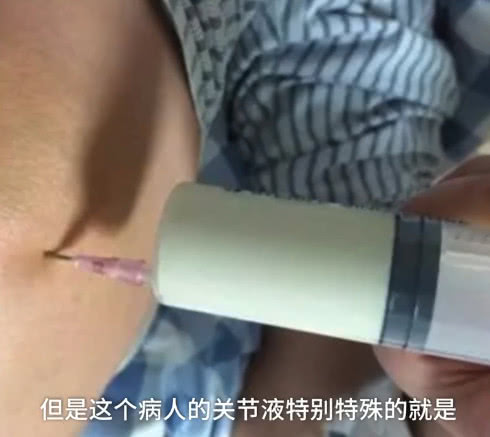 29岁男子关节抽出牛奶色液体，天天喝啤酒一天最多喝10瓶