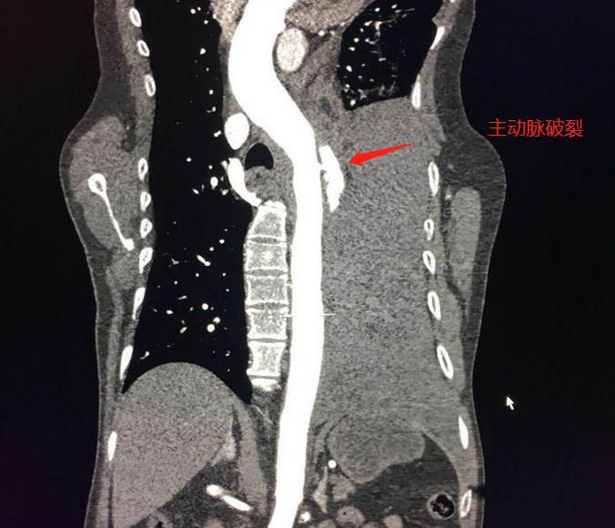 主动脉血管破裂能救吗,血压高主动脉夹层破裂