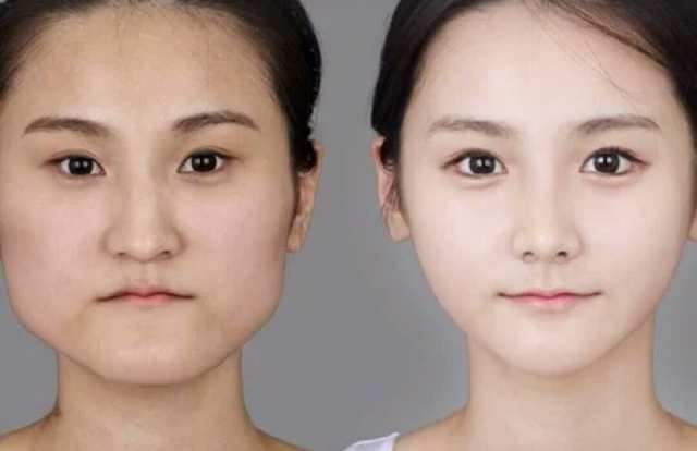 打了瘦脸针老了会变成什么样,打瘦脸针10天后变化图