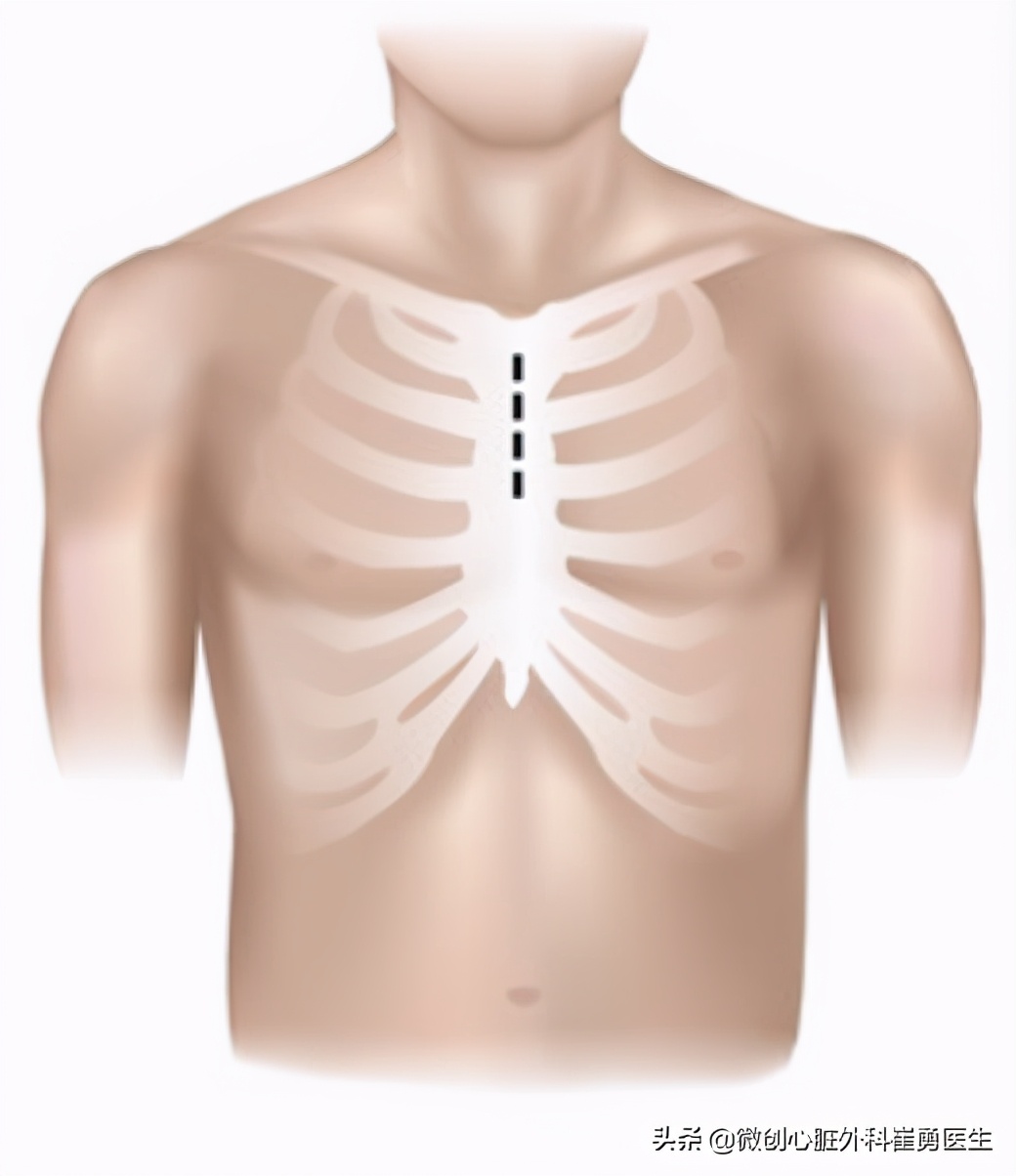 浙江省人民医院做心脏手术如何,浙江人民医院微创心脏手术