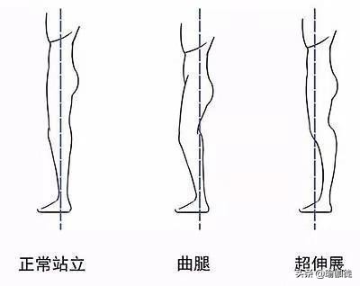 什么是膝盖过度伸展（膝盖超伸）？在瑜伽中怎么改善和正位？