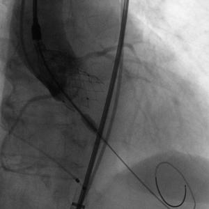 对造影剂过敏如何进行介入治疗,造影剂过敏迟发性治疗