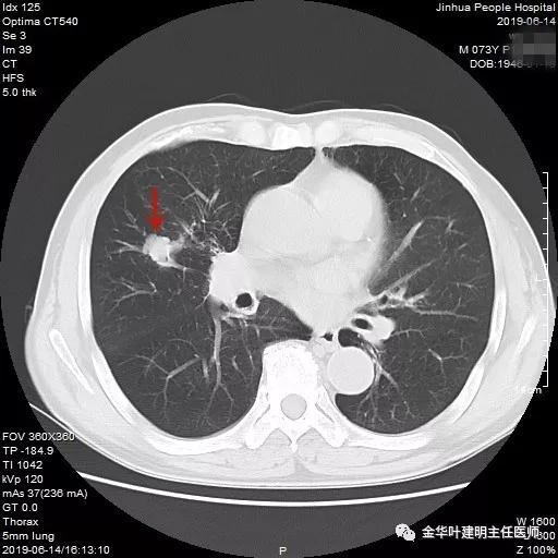 能不能手术,极重度混合性通气功能障碍能治吗