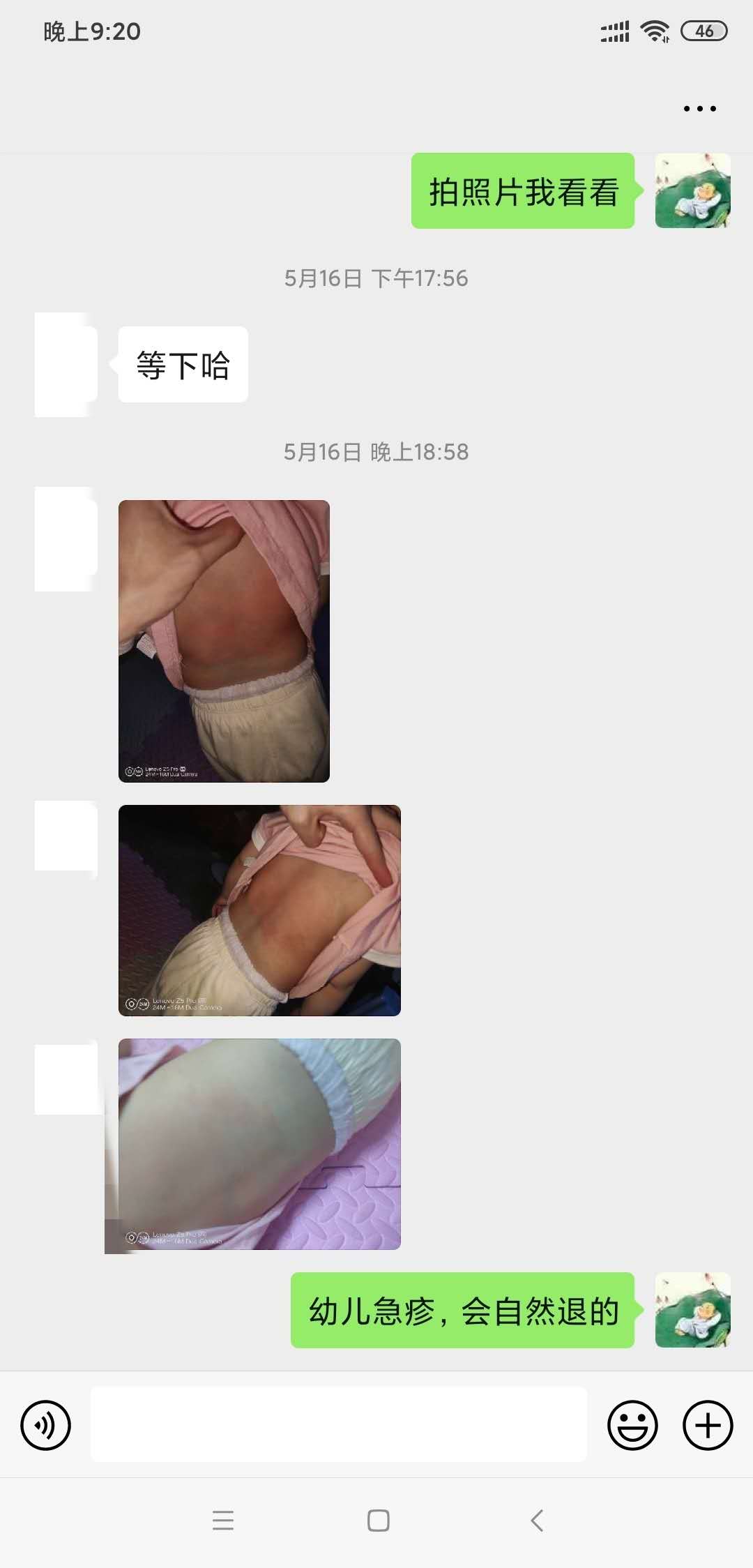 幼儿发热后的幼儿急疹中医处理,小儿急疹发烧有什么症状