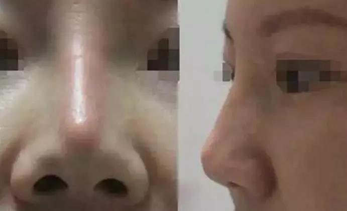 协和整形美容科专家,北京协和整形鼻综合