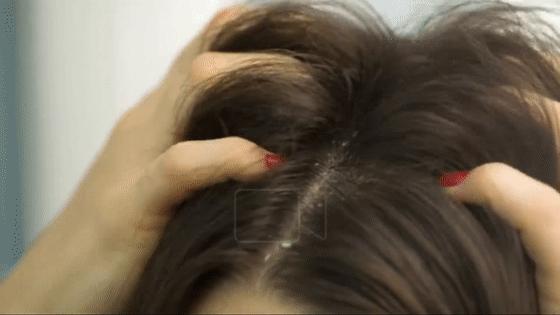 头皮一直出汗痒,头皮多痒出油掉发严重怎么办