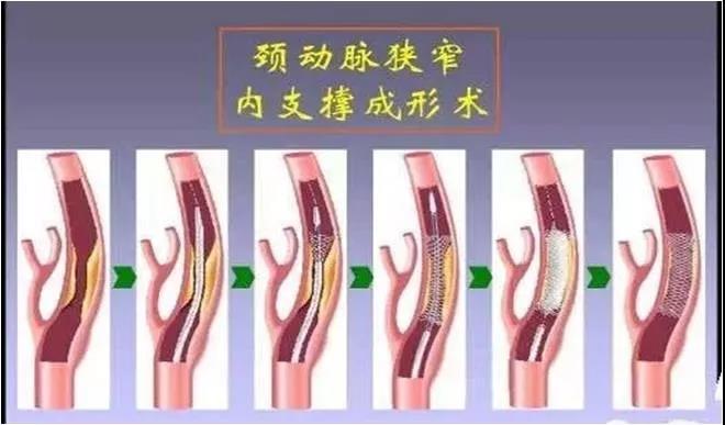 查颈动脉斑块挂什么科,颈动脉斑块的治疗方法