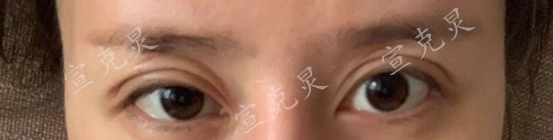 双眼皮整容毁容事件,整容毁容双眼皮