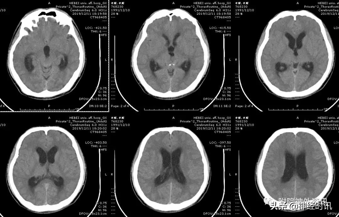 松果体占位怎样治疗,松果体区占位看什么科室