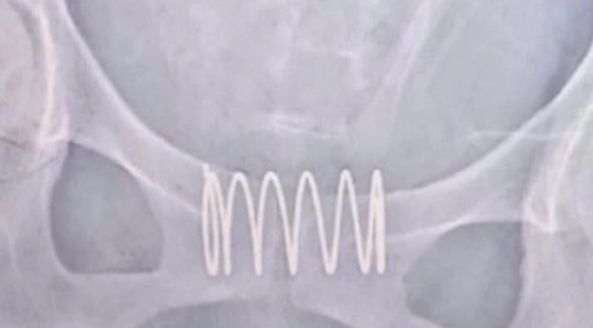 女子私密处竟塞入弹簧，原因令人哭笑不得