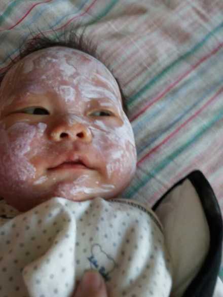 亲身经历带你走出宝宝湿疹的误区,婴幼儿湿疹最简单的自愈方法