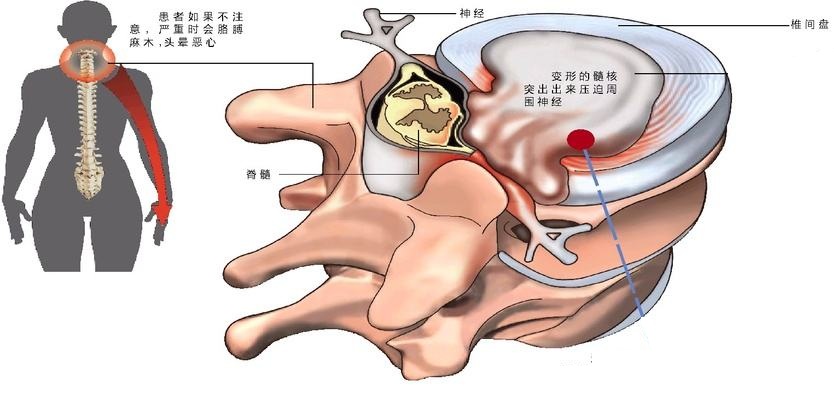 椎间盘突出压迫脊髓神经临床经验,颈椎间盘突出压迫脊髓有哪些症状