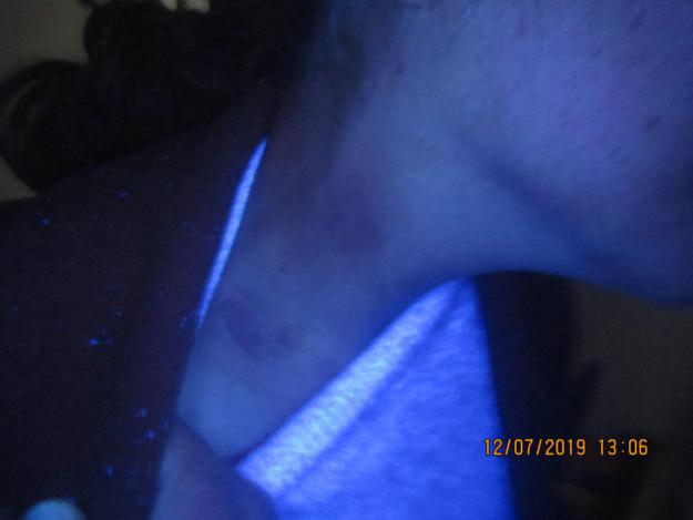 从确诊到康复，仅4个月，颈部白癜风患者王女士分享成功经验