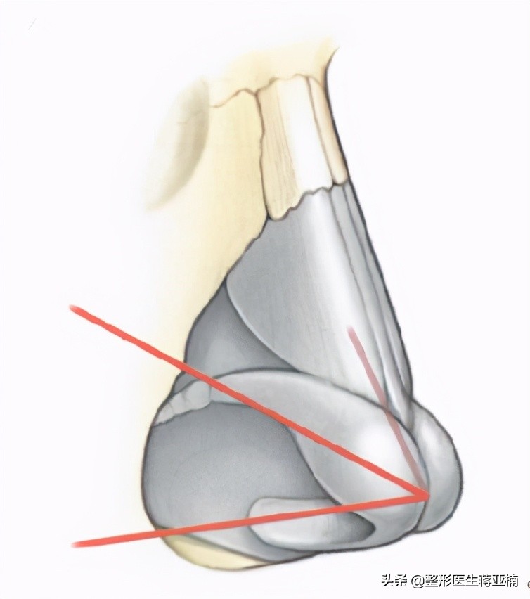 什么鼻整形需要经常修复,如何快速恢复隆鼻手术