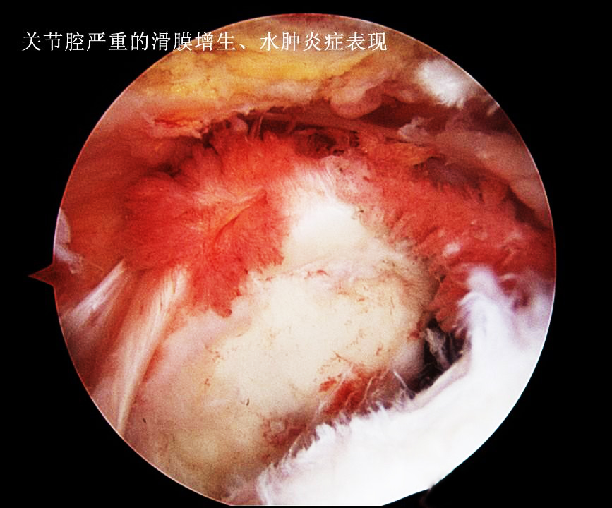 膝盖积水用烤灯能烤好吗?粗盐呢?医生:明确诊断针对治疗是关键