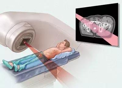 肿瘤放射治疗学,放射治疗是利用什么效应