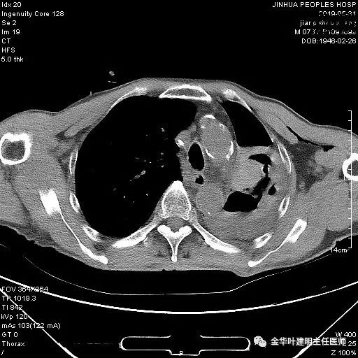 手术引起乳糜胸,有没有做了肺结节手术后是误诊的