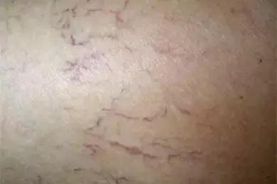 祛斑面诊必背知识点,要祛斑