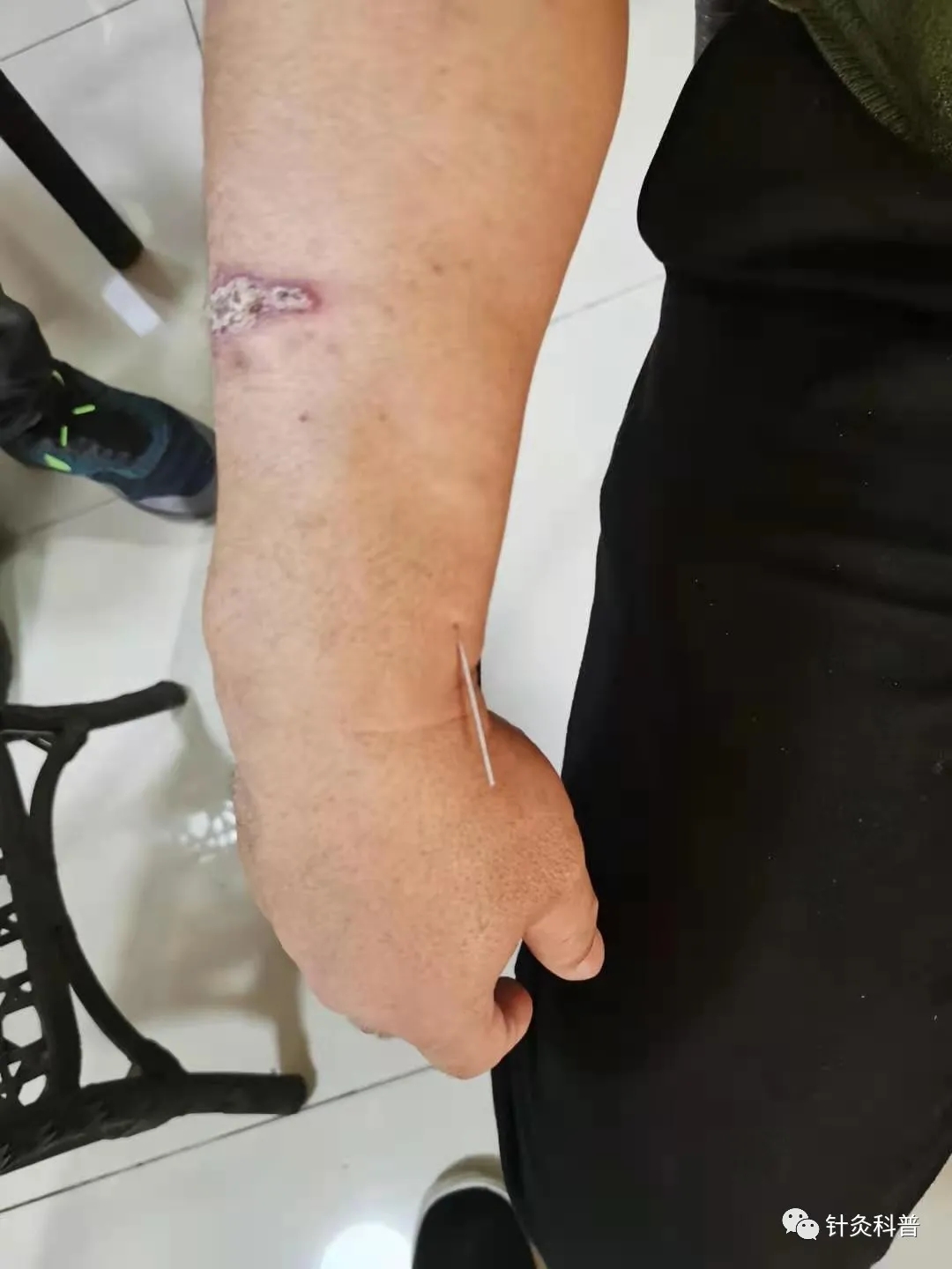 肩背痛一针针灸法,针灸治疗颈肩腰腿痛