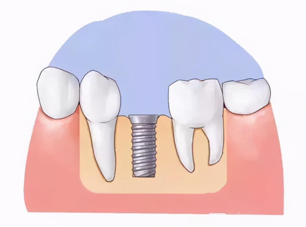 七个步骤带你了解种植牙全过程,种植牙的全过程步骤