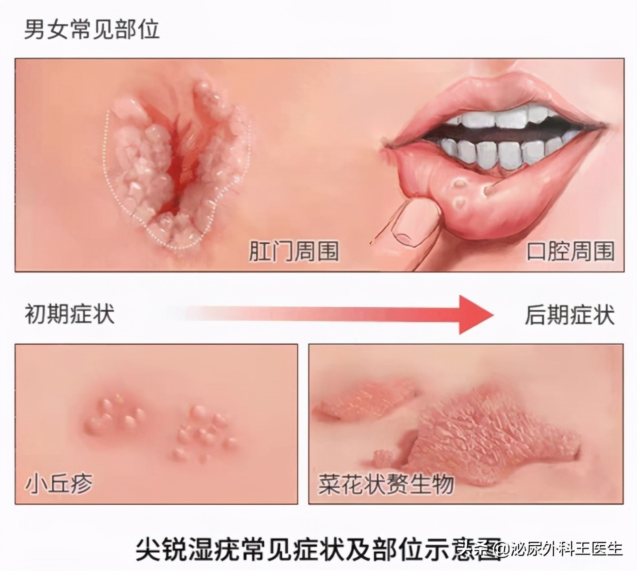 肛门摸到了小肉球,是痔疮还是尖锐湿疣?医生来教你区分