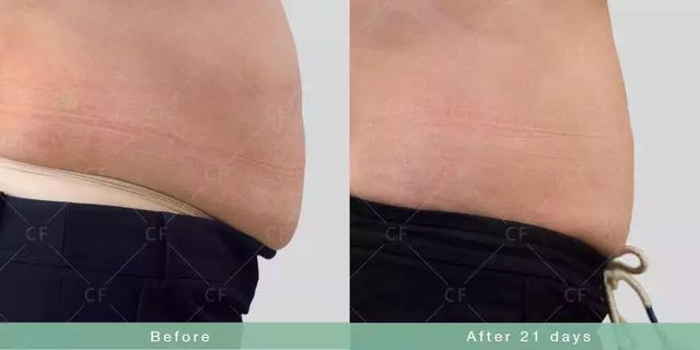 如何瘦双下巴和婴儿肥,小孩怎么快速减掉双下巴