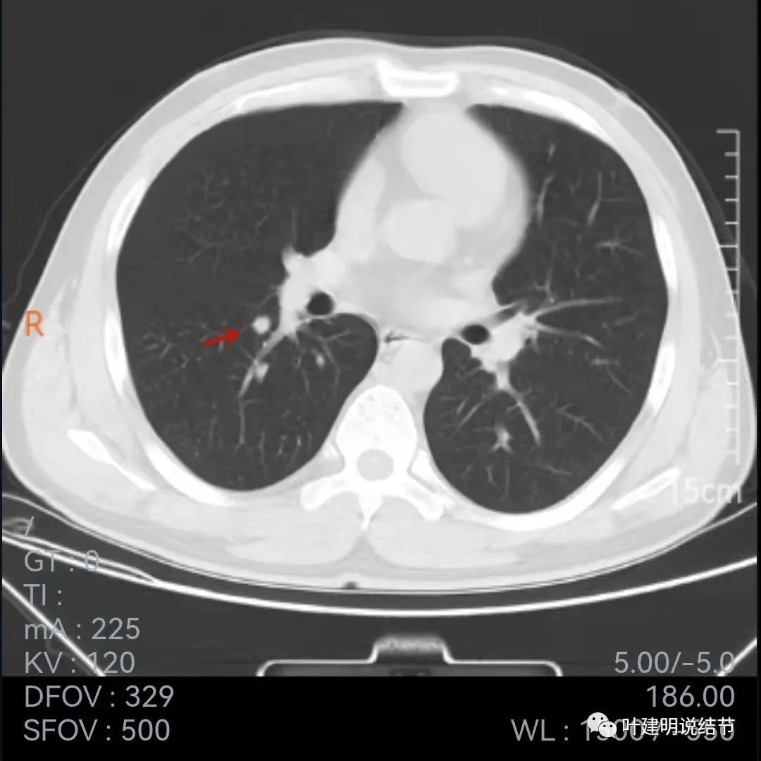 问诊分析：存在了4年的实性结节会不会是肺癌？
