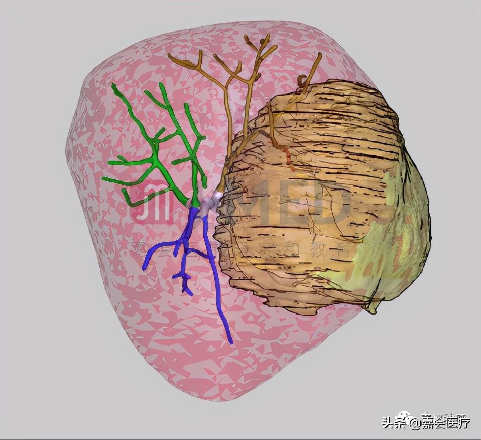 7mmx5mm肝癌能治愈吗,巨大型肝癌的治疗方法