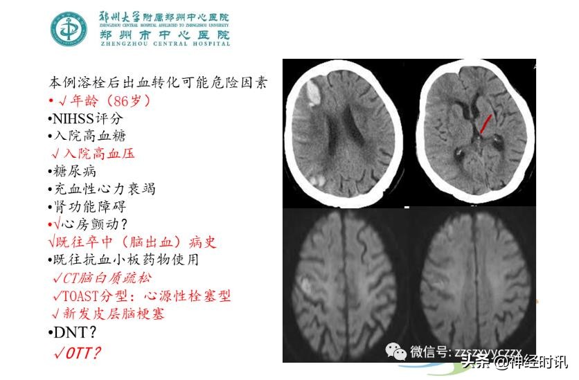 静脉溶栓怎么引起的,静脉相关并发症的预防及处理