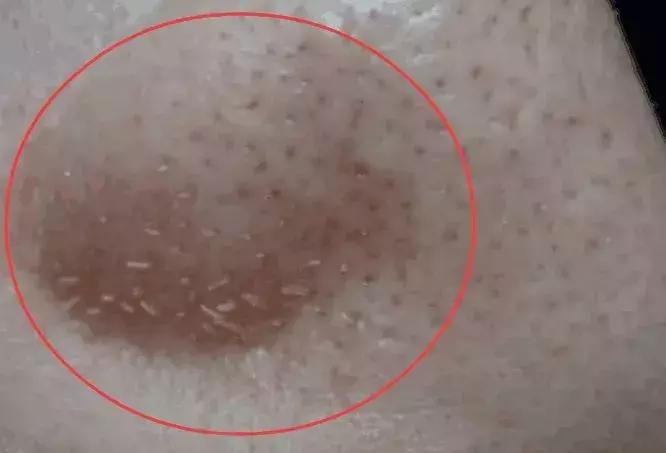 为了祛痘,小伙买10条活蚂蟥放脸上!结果悲剧了……