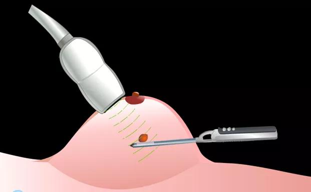 乳腺结节开刀经历几个阶段,乳腺结节切了是不是就治愈了呢