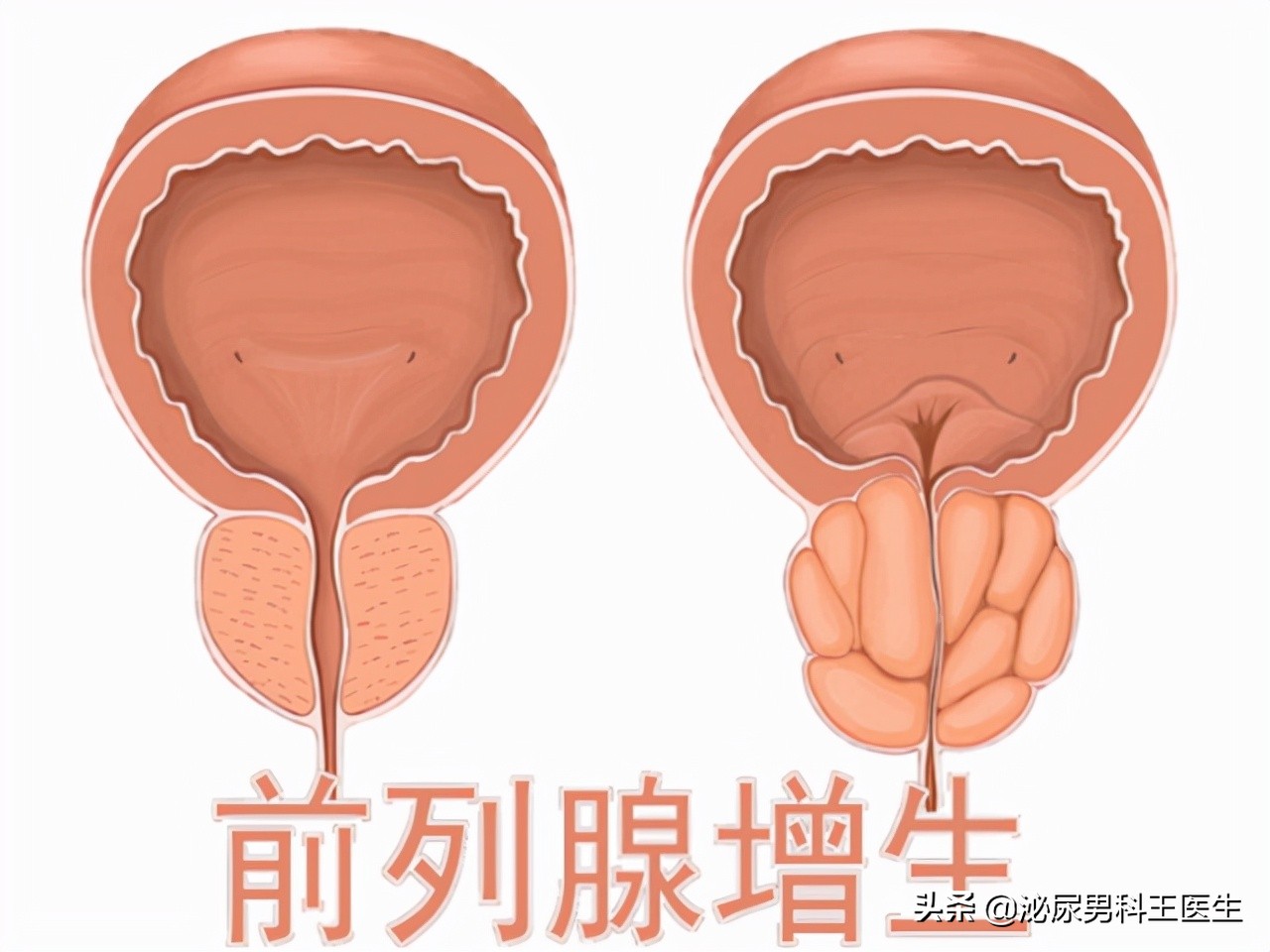 枸橼酸西地那非有没有治早泄功能,枸橼酸西地那非片有治病的功能吗