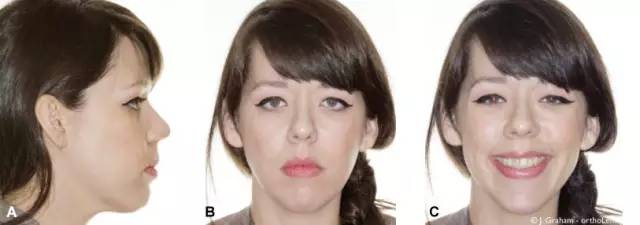 笑露牙龈怎么整,笑露牙龈怎么矫正训练