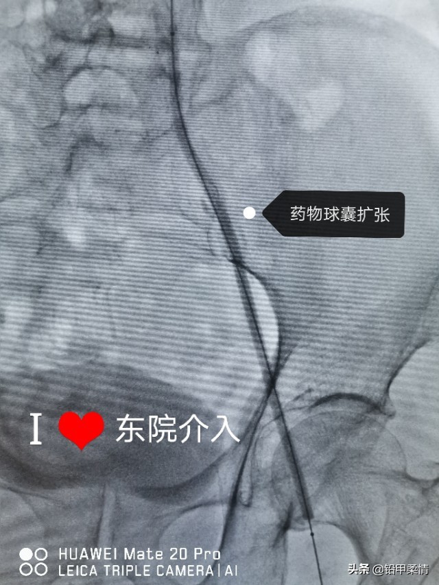 治疗髂总动脉起始端闭塞的专家,年轻人髂动脉闭塞怎么治疗