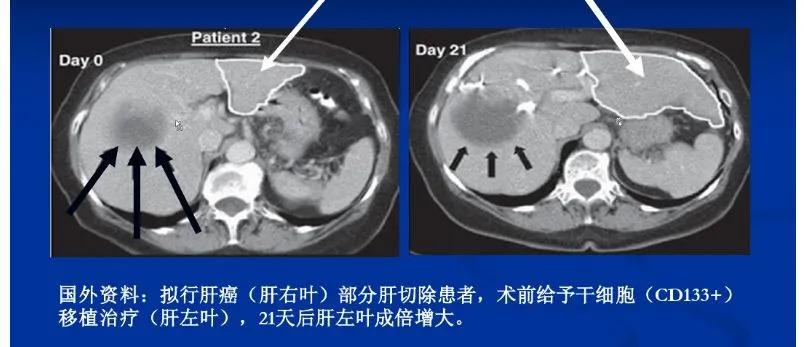 干细胞能治疗肝病吗,干细胞治疗肝病能维持多久