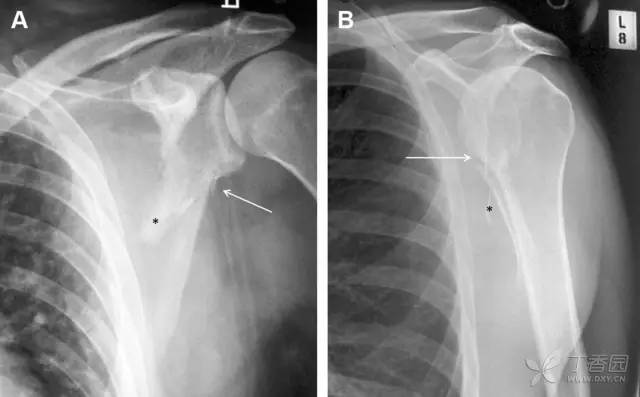 常见的八种骨折,容易漏诊的肩关节骨折