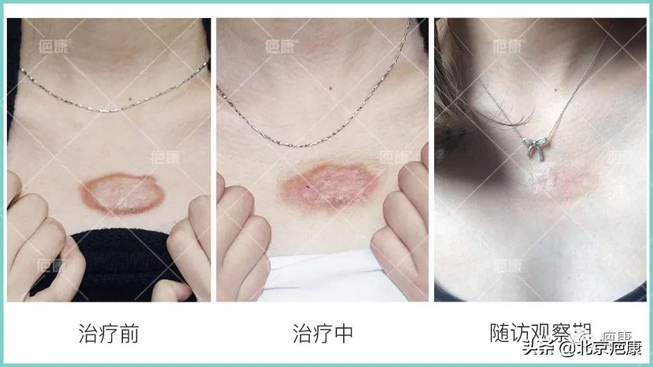 疤痕修复美容仪器多少钱,疤痕增生最好的仪器